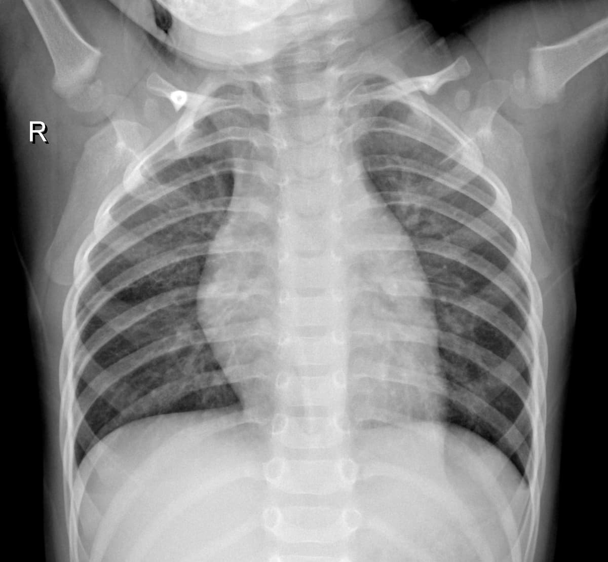 Radiografia Normal — NIH Chest X-ray14