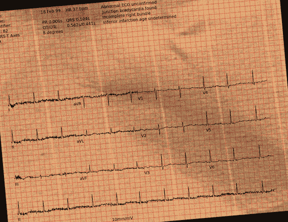 Normal ECG — PTB-XL