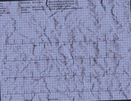Normal ECG — PTB-XL