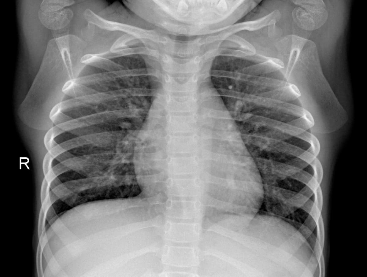 Radiografia Normal — NIH Chest X-ray14