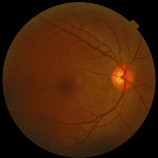 No Diabetic Retinopathy — MESSIDOR-2