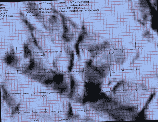 Normal ECG — PTB-XL