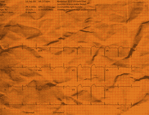 Normal ECG — PTB-XL