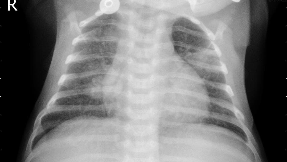 Pneumonia — NIH Chest X-ray14