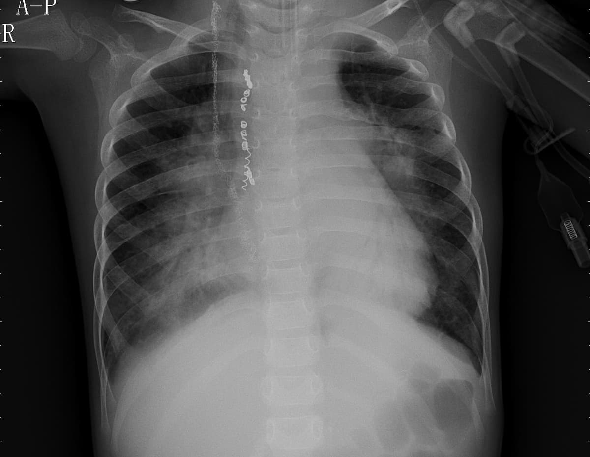 Pneumonia — NIH Chest X-ray14