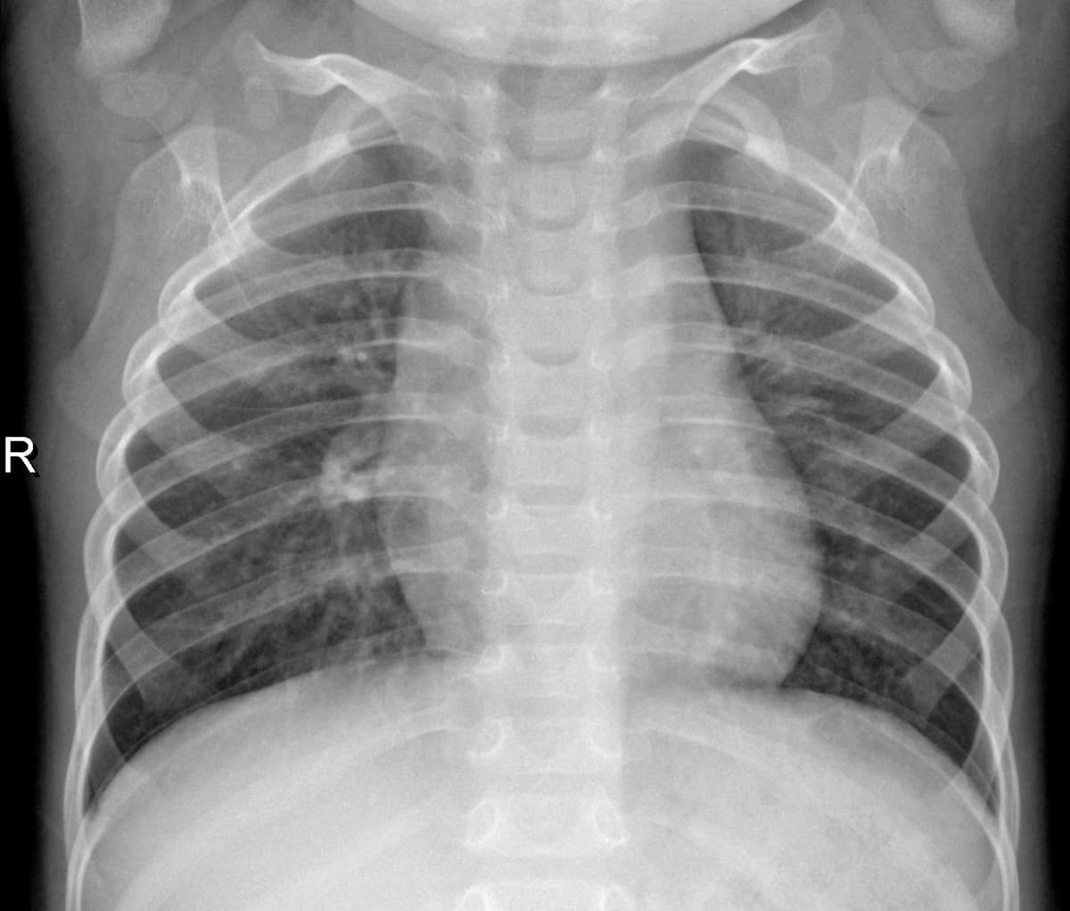 Radiografia Normal — NIH Chest X-ray14