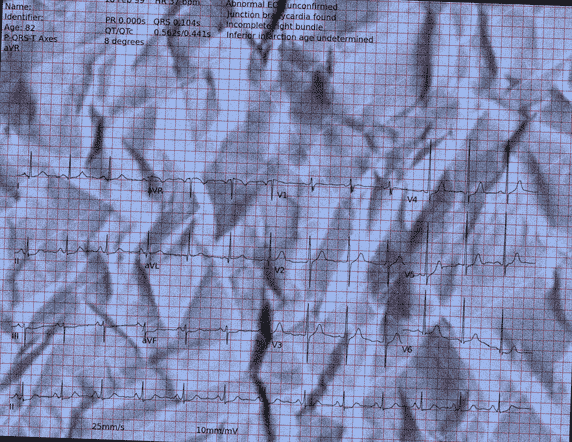 Normal ECG — PTB-XL