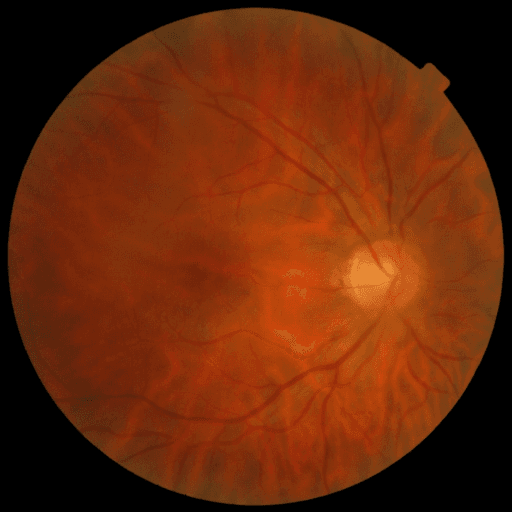 Proliferative DR — MESSIDOR-2