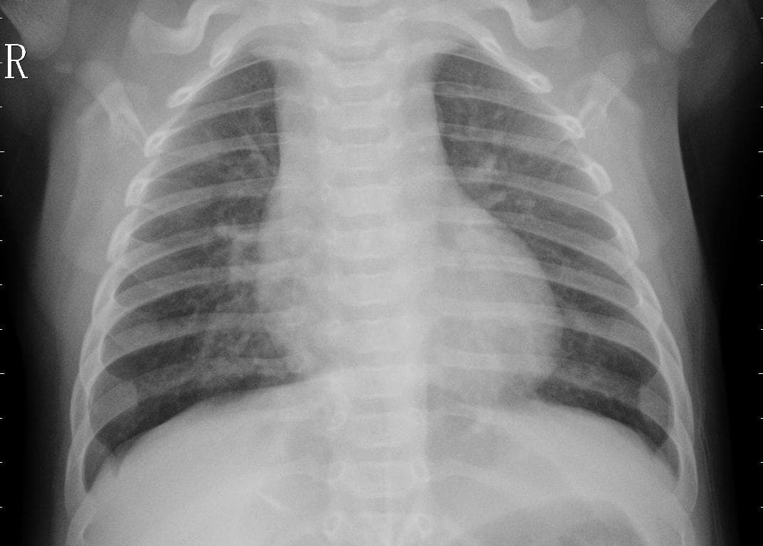 Pneumonia — NIH Chest X-ray14