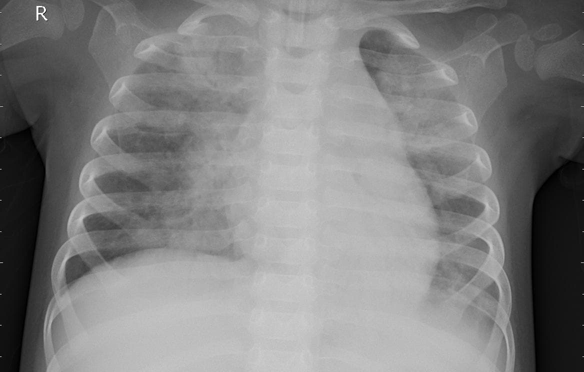 Pneumonia — NIH Chest X-ray14