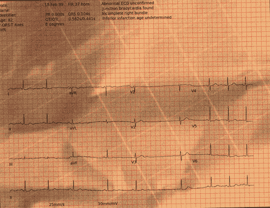 Normal ECG — PTB-XL