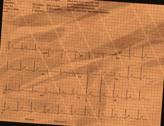 Normal ECG — PTB-XL