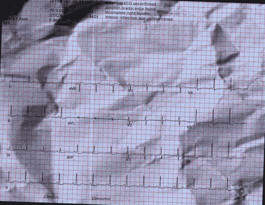 Normal ECG — PTB-XL