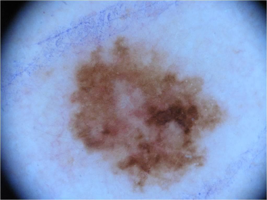 Dermatofibroma — ISIC Archive