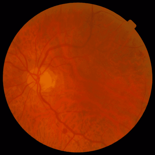 No Diabetic Retinopathy — MESSIDOR-2