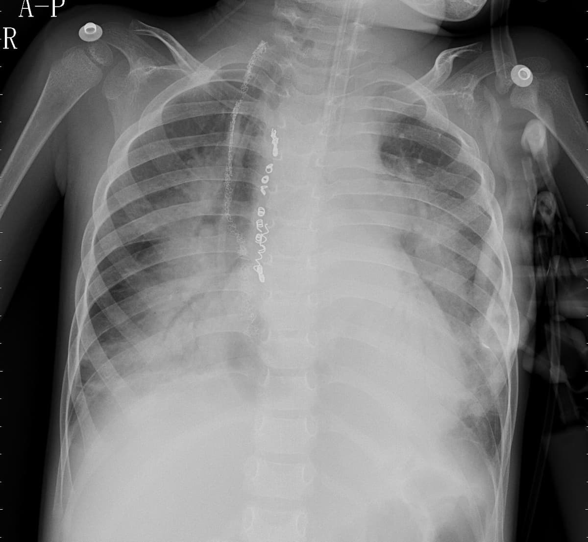 Pneumonia — NIH Chest X-ray14