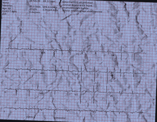 Normal ECG — PTB-XL