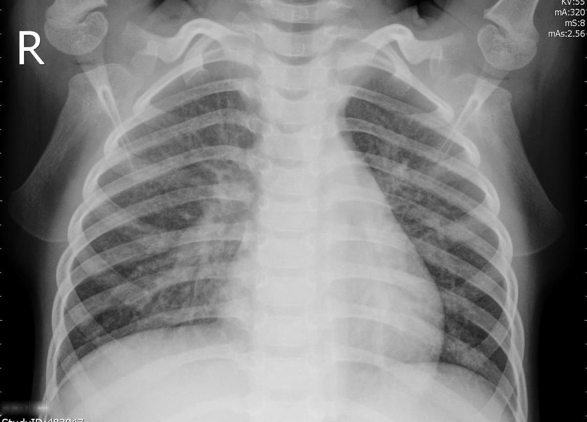 Pneumonia — NIH Chest X-ray14
