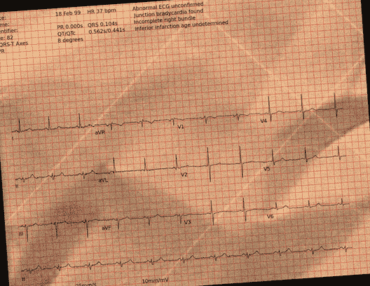 Normal ECG — PTB-XL