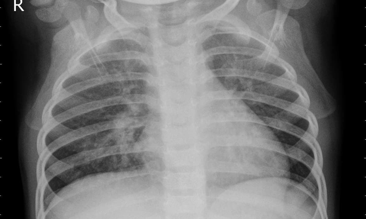 Pneumonia — NIH Chest X-ray14