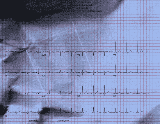 Normal ECG — PTB-XL