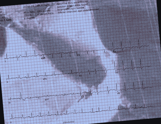 Normal ECG — PTB-XL