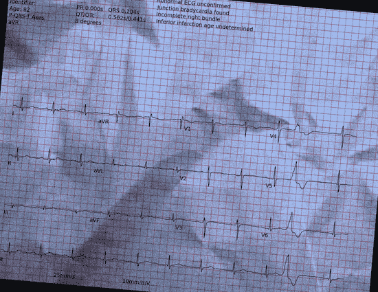 Normal ECG — PTB-XL