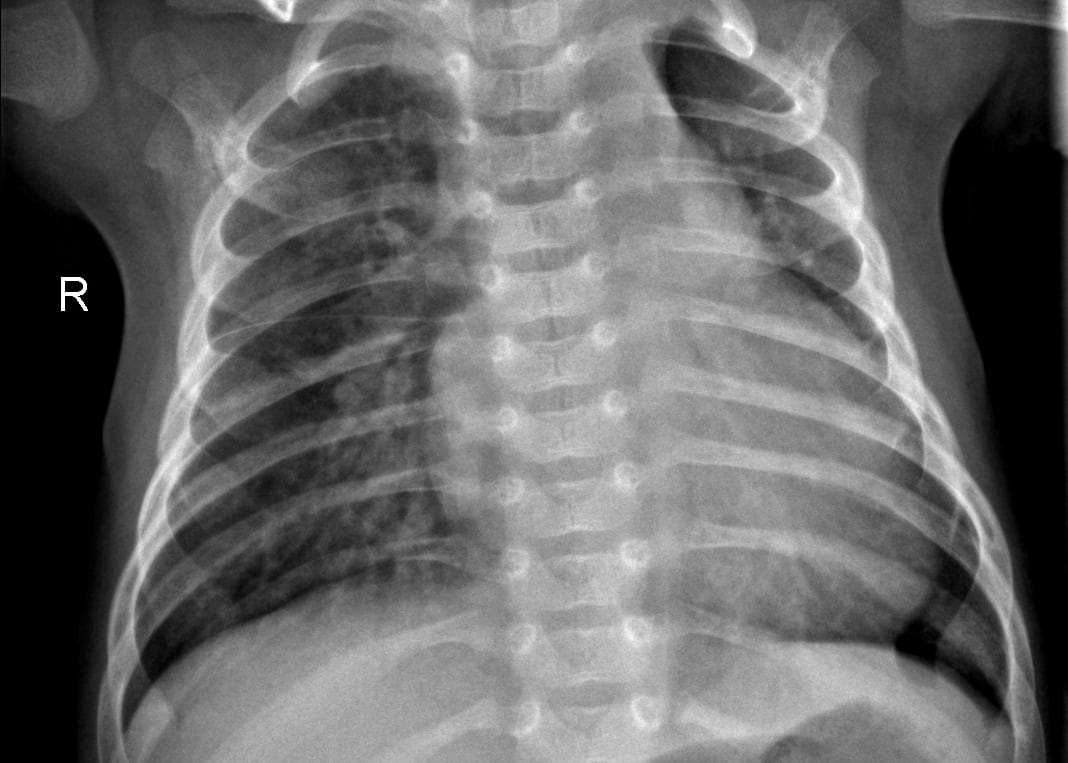 Pneumonia — NIH Chest X-ray14