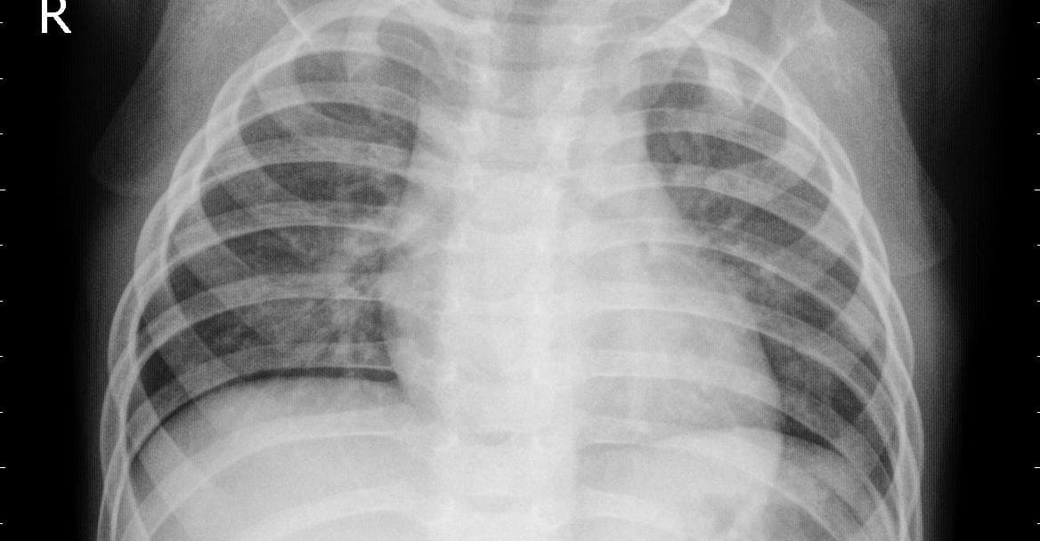 Pneumonia — NIH Chest X-ray14