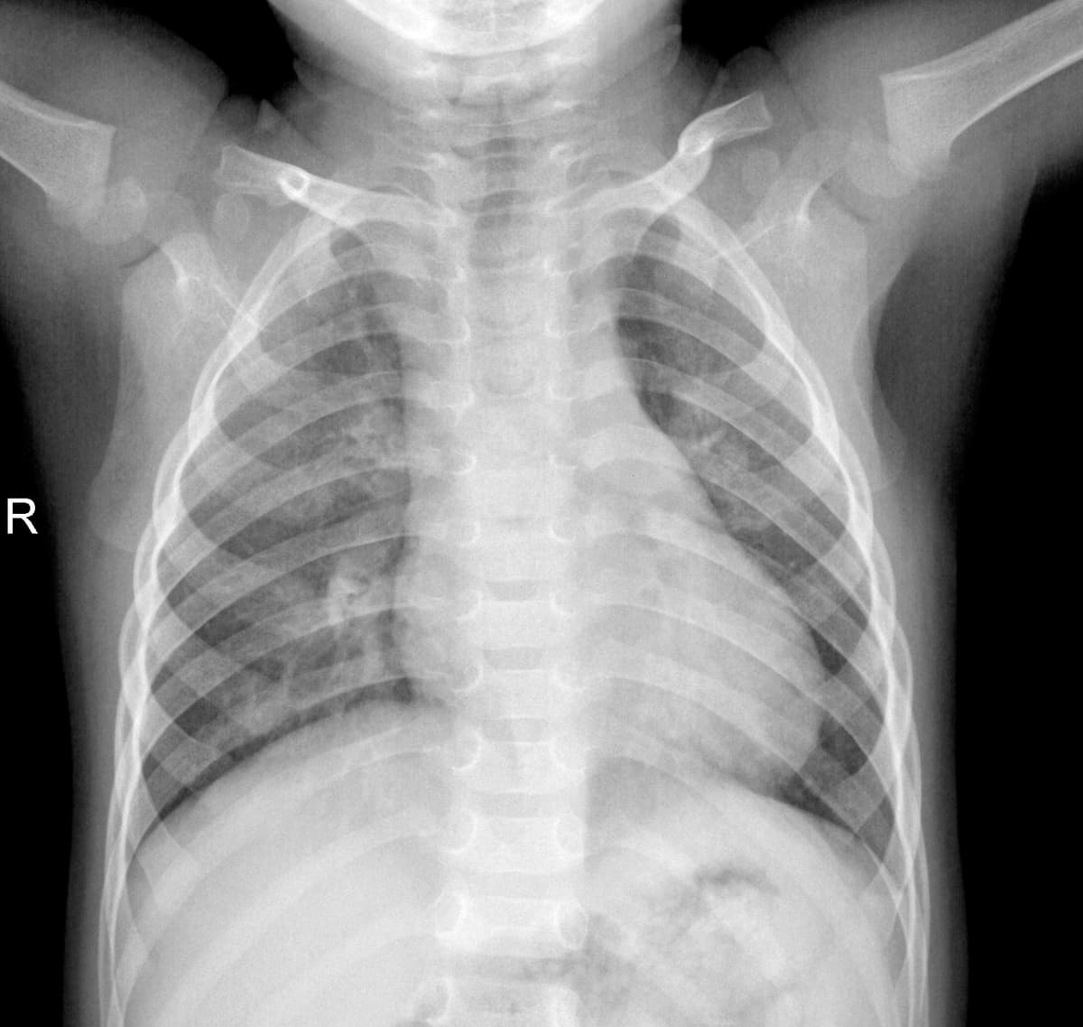 Radiografia Normal — NIH Chest X-ray14
