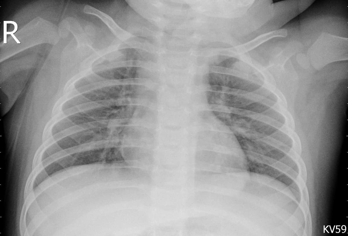 Pneumonia — NIH Chest X-ray14