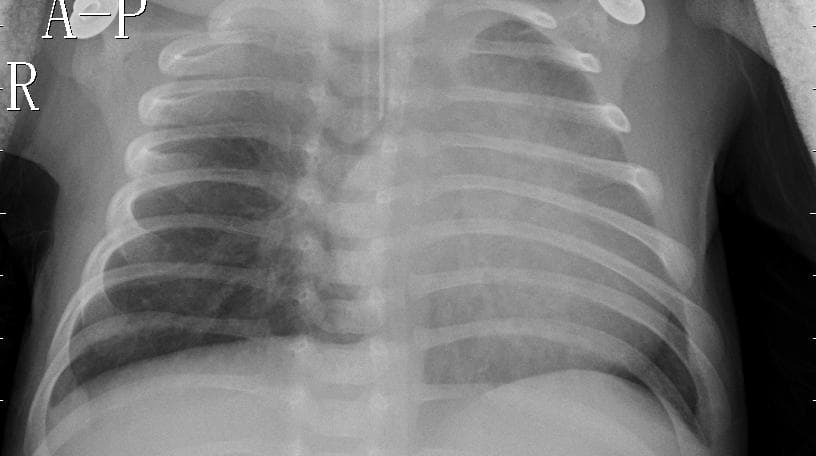 Pneumonia — NIH Chest X-ray14