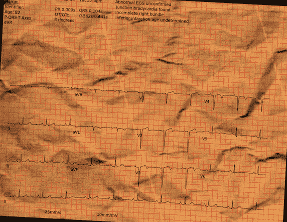 Normal ECG — PTB-XL