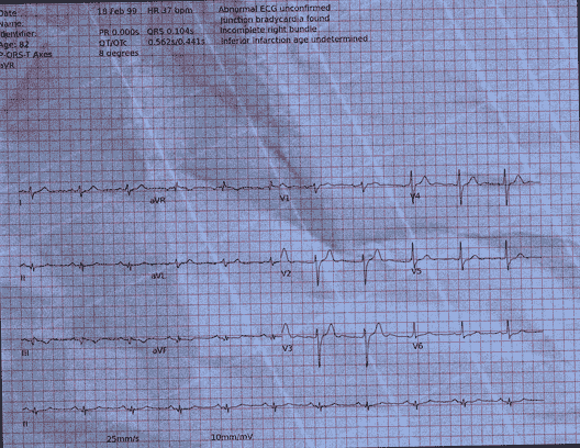 Normal ECG — PTB-XL