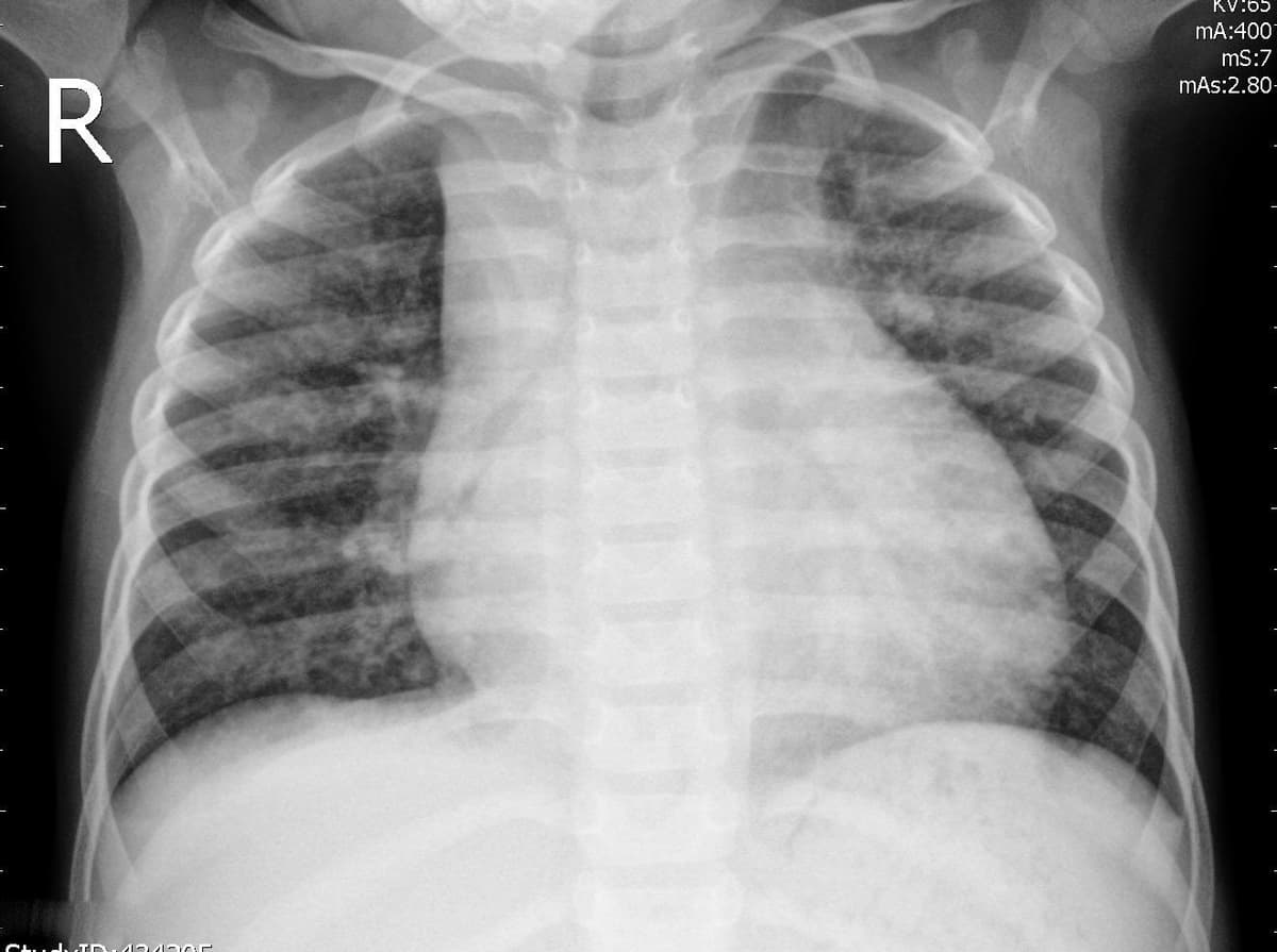 Pneumonia — NIH Chest X-ray14