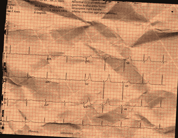 Normal ECG — PTB-XL