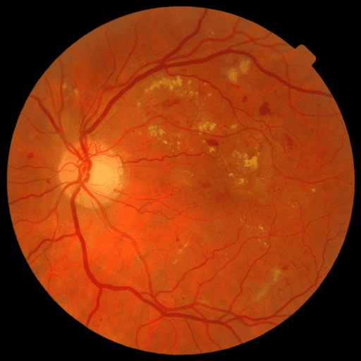 No Diabetic Retinopathy — MESSIDOR-2