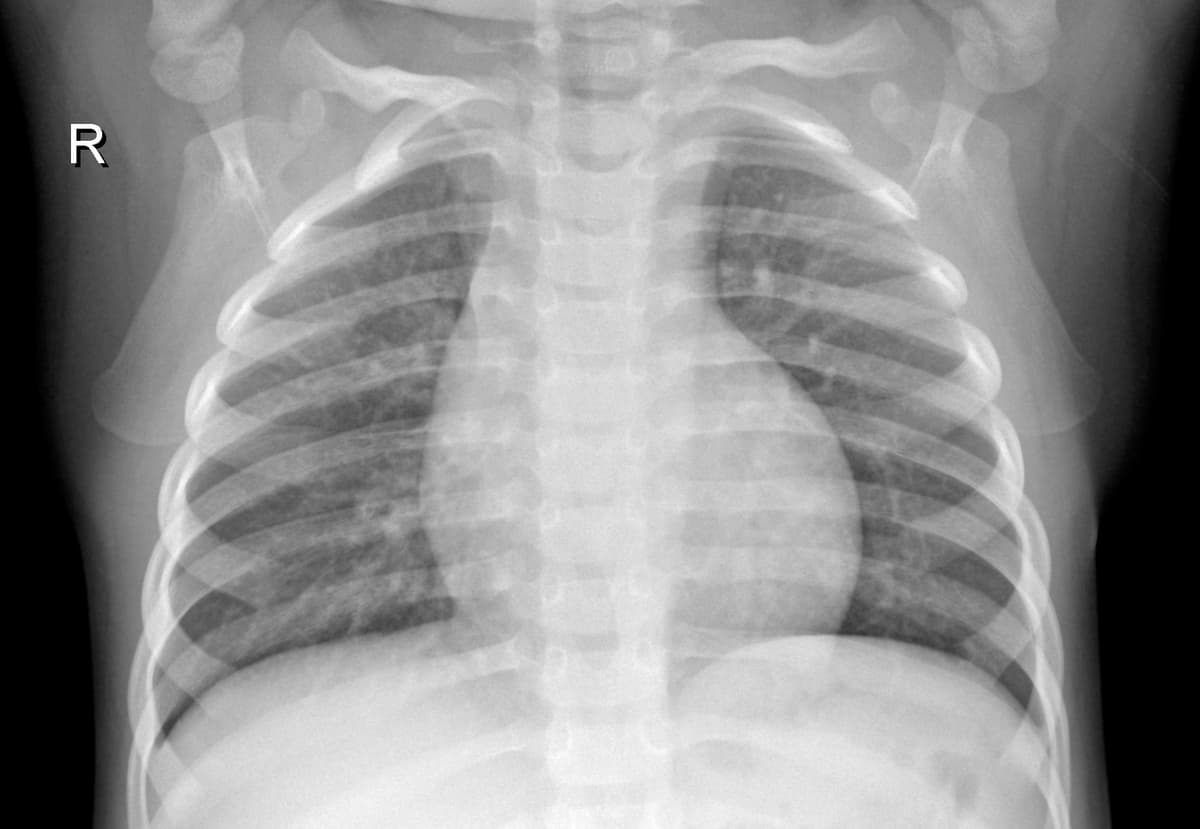 Radiografia Normal — NIH Chest X-ray14