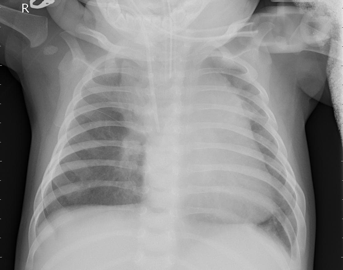 Pneumonia — NIH Chest X-ray14