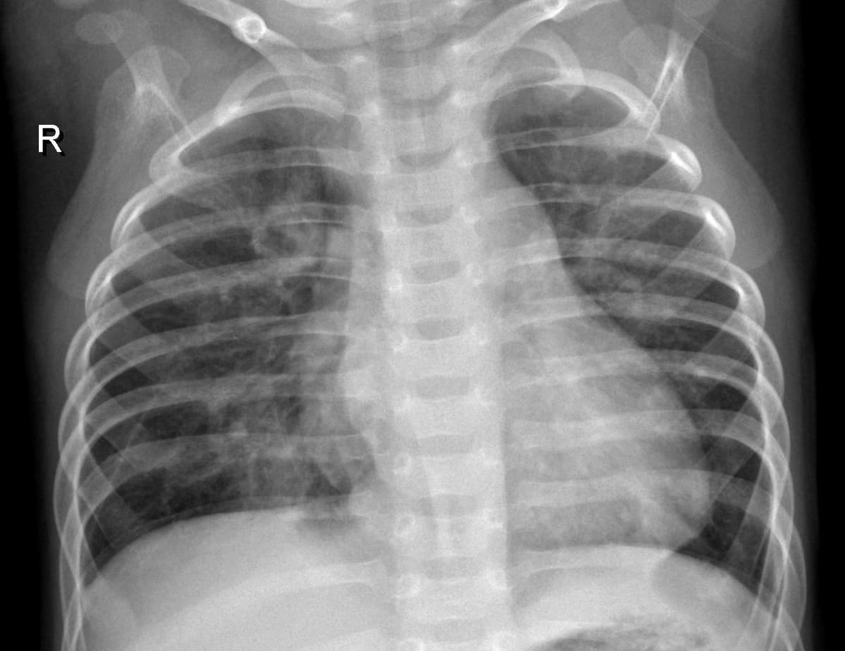 Pneumonia — NIH Chest X-ray14