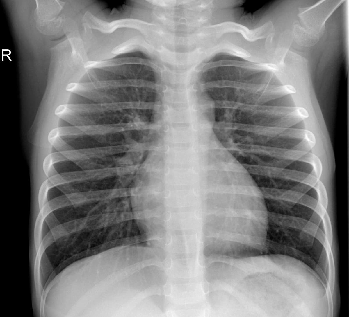 Radiografia Normal — NIH Chest X-ray14