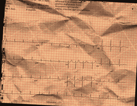 Normal ECG — PTB-XL