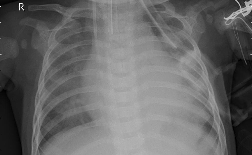 Pneumonia — NIH Chest X-ray14