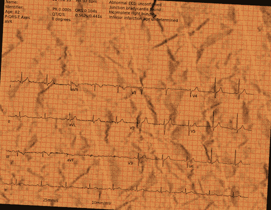 Normal ECG — PTB-XL