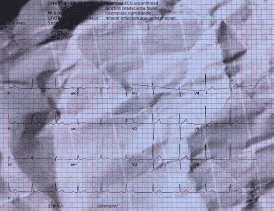 Normal ECG — PTB-XL