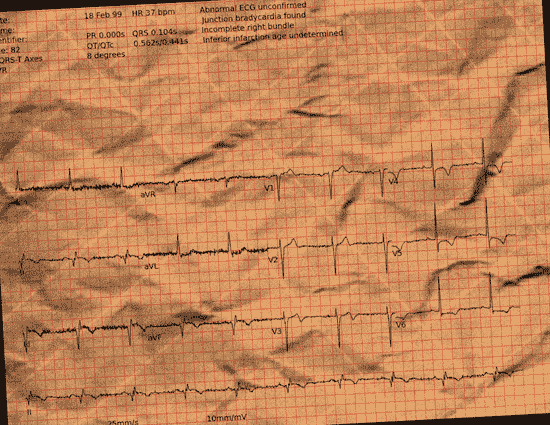 Normal ECG — PTB-XL