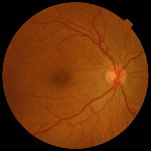 No Diabetic Retinopathy — MESSIDOR-2