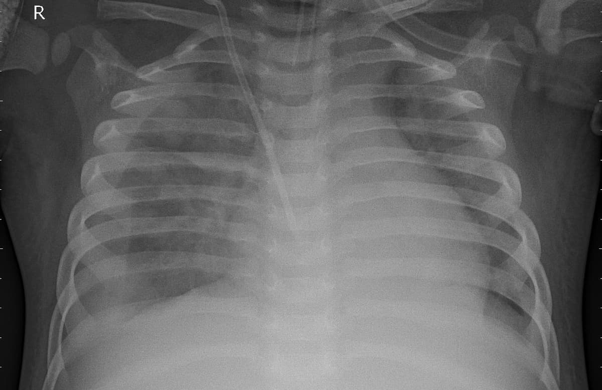 Pneumonia — NIH Chest X-ray14