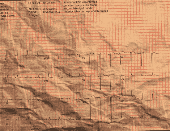 Normal ECG — PTB-XL