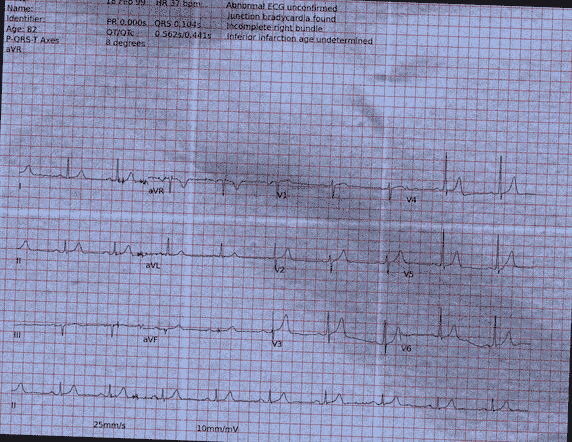 Normal ECG — PTB-XL